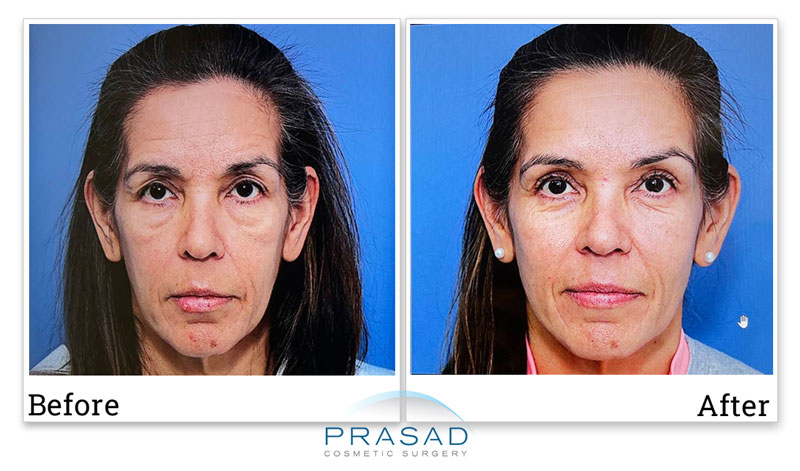 before-and-after blepharoplasty of female patient in her late 50s