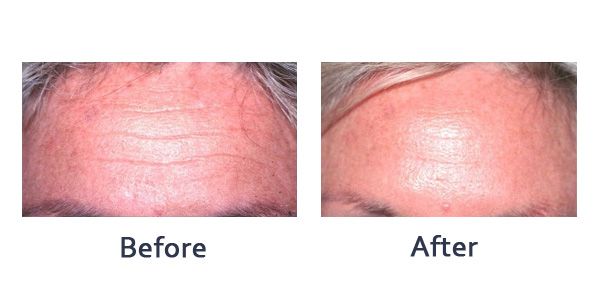botox on forehead before and after