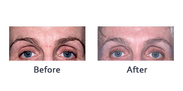 before and after botox or dysport treatment