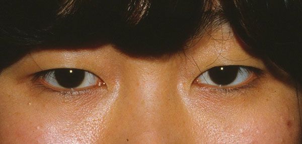 blepharoplasty in asian patient