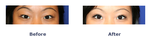 Before And After Asian Double Eyelid Surgery