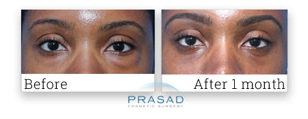 eye bag surgery reviews before and after 1 month photo submitted by patient