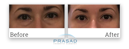 Eye bags treatment before and after photo submitted by patient