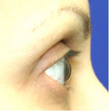 before eyelash transplant - patient sideview