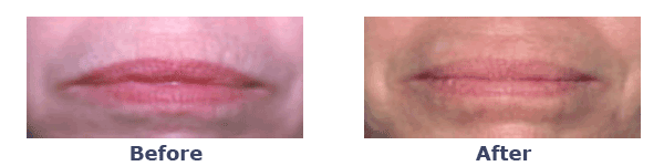 laser skin rejuvenation on lip lines