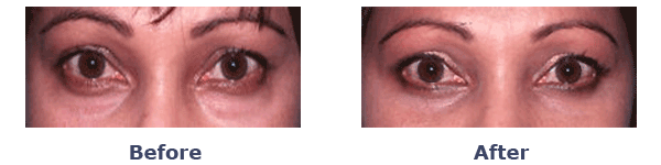 female under eye bags before and after