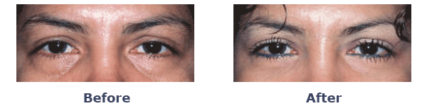 lower eyelid surgery before and after performed by blepharoplasty specialist of New York