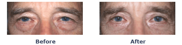 old man bags under eyes