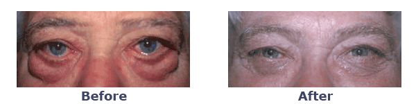 old man severe under eye bags