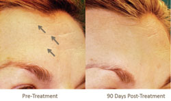 Single Pelleve Treatment For Forehead Wrinkles