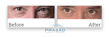 old male patient before and after under eye bag surgery results