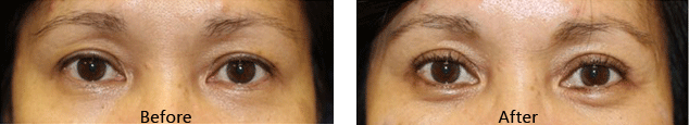 pelleve treatment for eye area before and after treatment