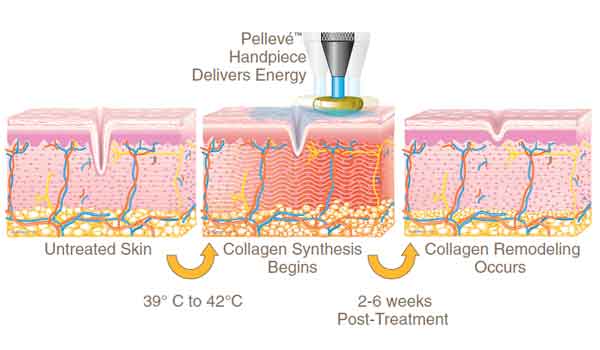 How Pelleve Work illustration