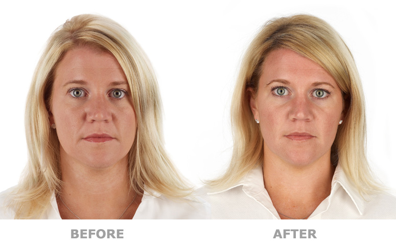 before and after Platelet Rich Plasma Treatment, New York