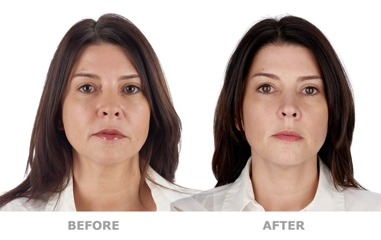 before and after Platelet Rich Plasma therapy