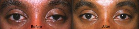 congenital ptosis surgery before and after