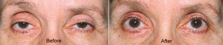 age related ptosis before and after ptosis surgery