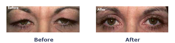 Before And After Ptosis Surgery Female