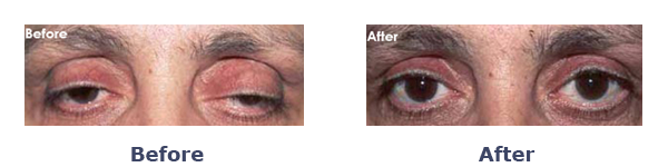 Before And After Ptosis Surgery Female