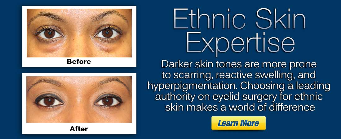 click here to learn more about dark skin eyelid surgery