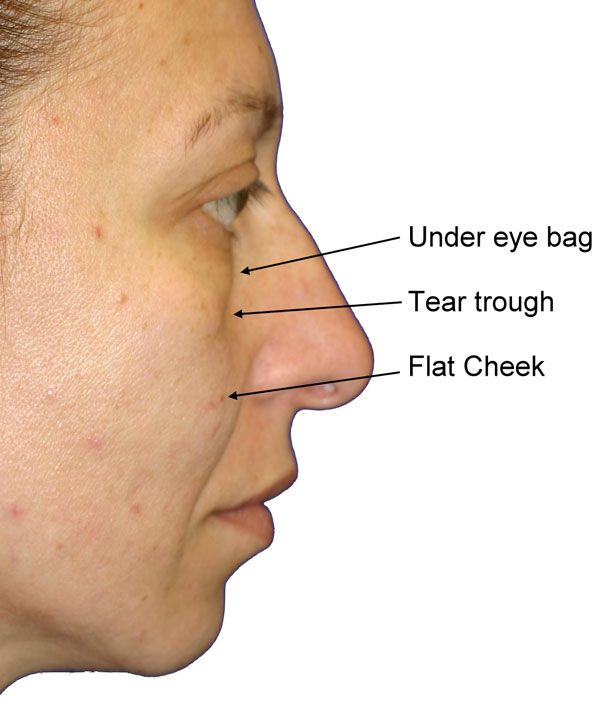 under eye bag, Tear Trough, and flat cheek illustration