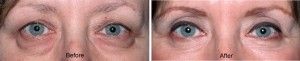 patient with under eye bags before and after eye bag removal surgery