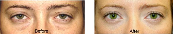 before and after lower eyelid blepharoplasty performed by Dr. Prasad