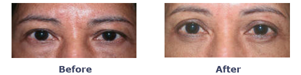 upper eyelid lift before and after