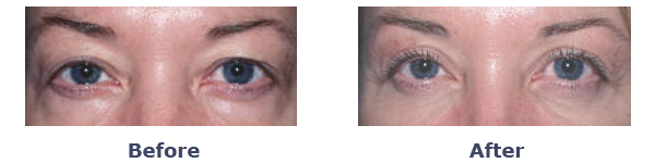 Upper Eyelid Surgery Patient Before and After