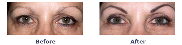 before and after upper eyelid crease