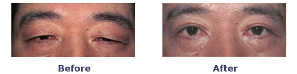 drooping eyelids before and after photos