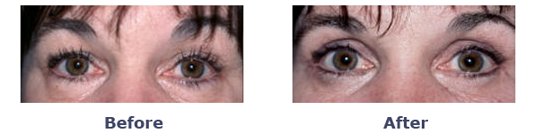 female before-and-after upper and lower eyelid surgery