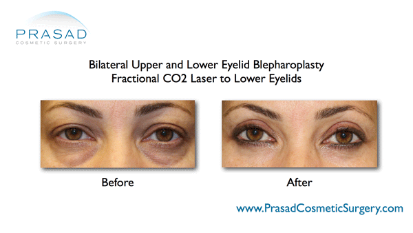 treatment for under eye wrinkles and bags before and after