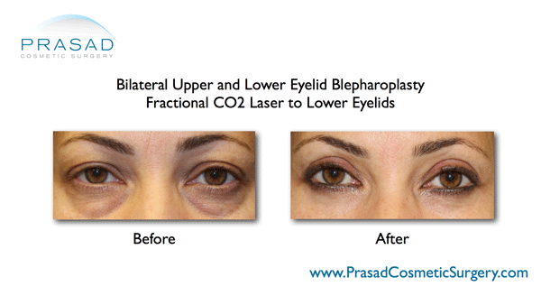 https://puffyeyes.com/wp-content/uploads/upper-and-lower-eyelid-blepharoplasty-prp-to-lower-eyelids-Dr-Amiya-Prasad-www-PrasadCosmetic-Surgery-com.gif