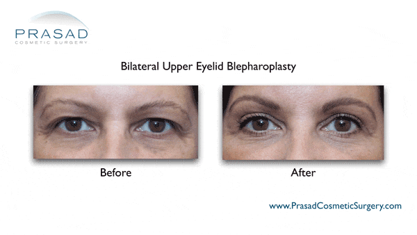 before and after upper eyelid blepharoplasty