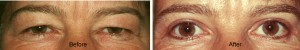 before and after upper eyelid surgery - older female patient